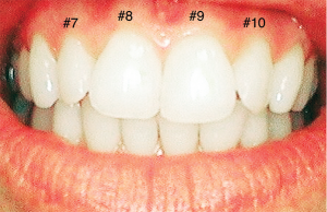 Composite veneers