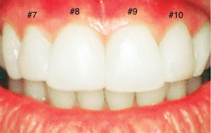 Before (top): The patient disliked the rotation of her teeth and the discrepancy in size and shape. Dentist evaluation: #7 rotated outward to the right, #8 rotated toward middle, #9 rotated toward middle, #10 rotated outward to the left. After (bottom): Composite veneers placed on four front teeth make them look straight, aesthetic and more evenly shaped.