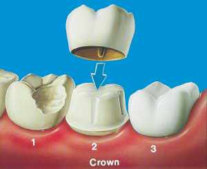 dental crown