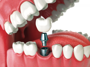 DENTAL implant