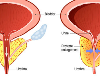 New Solution for an Enlarged Prostate