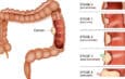 Colon Cancer Now Top Cancer Killer for People Under 50